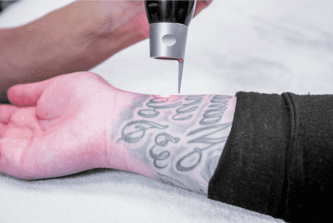 Borrar-tatuajes